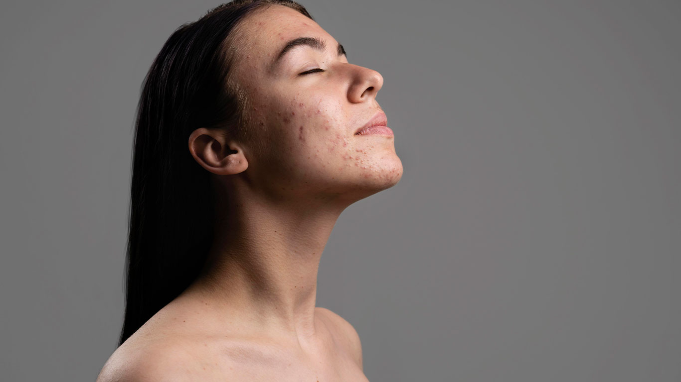 Feelthelion treatments for acne